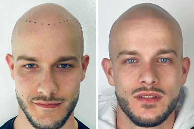 effet crane rase - résultat face - patient Anthony